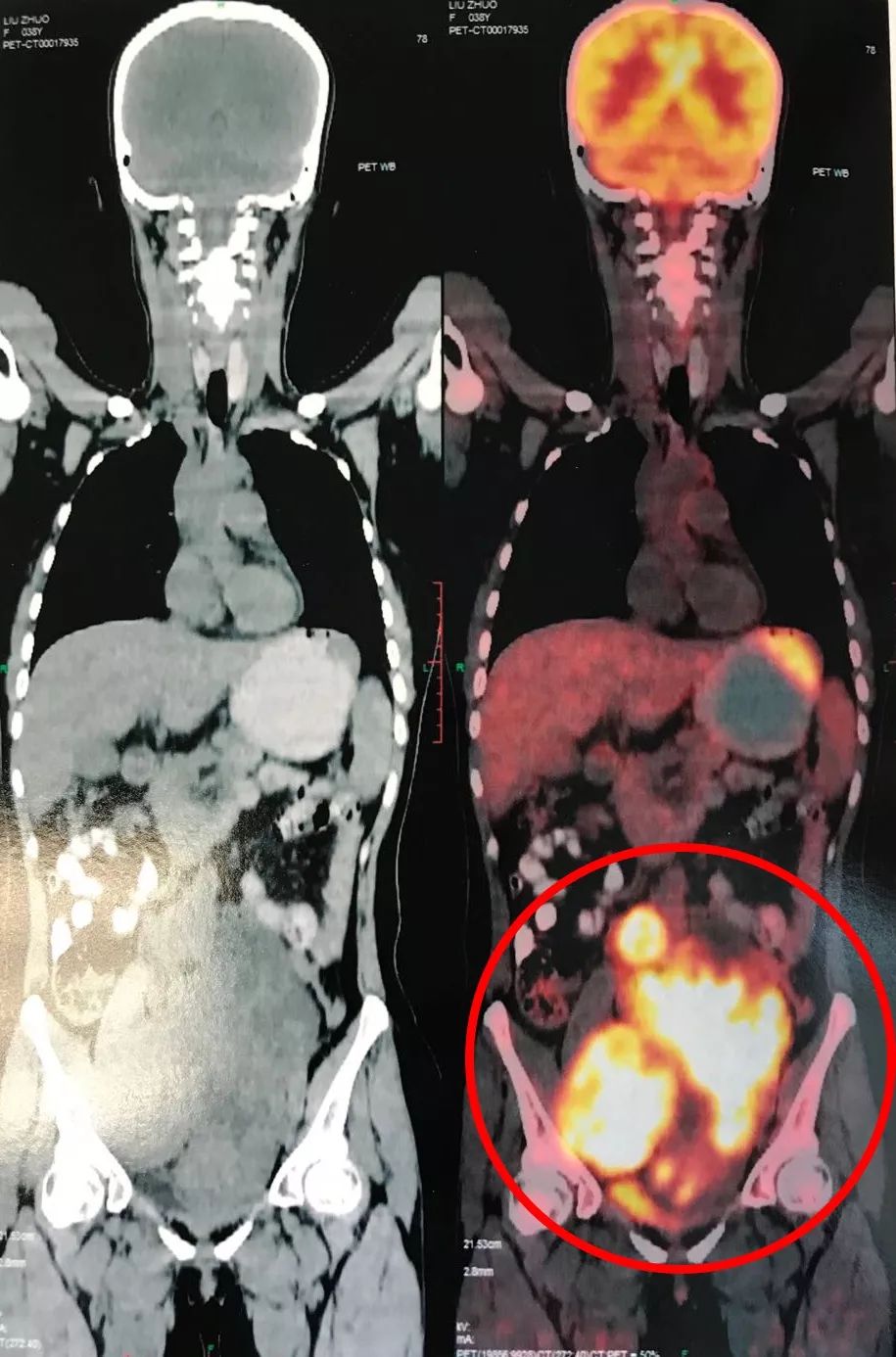 泰国回来后得白血病,泰国回来得了癌症