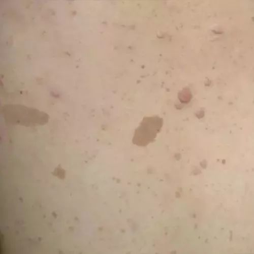 咖啡斑是孕期不忌口长的吗,孩子为什么长咖啡斑