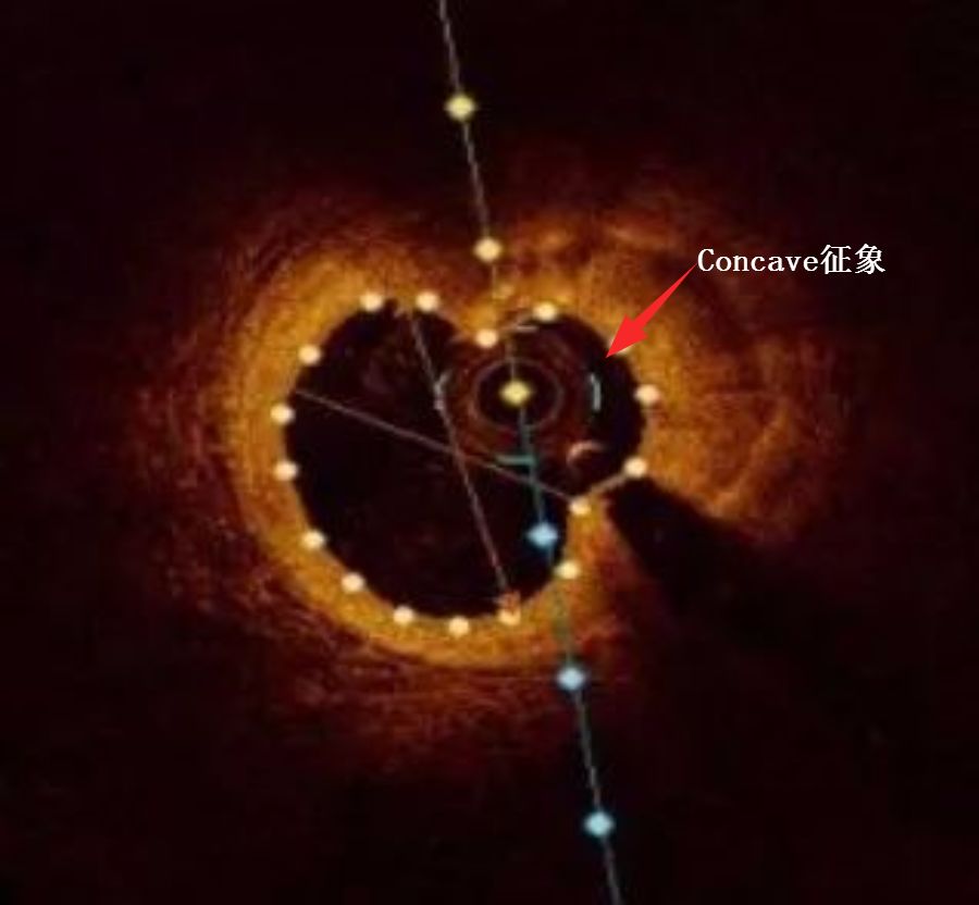 oct閽欏寲鐥呭彉,cit2019灞曚細瑙嗛