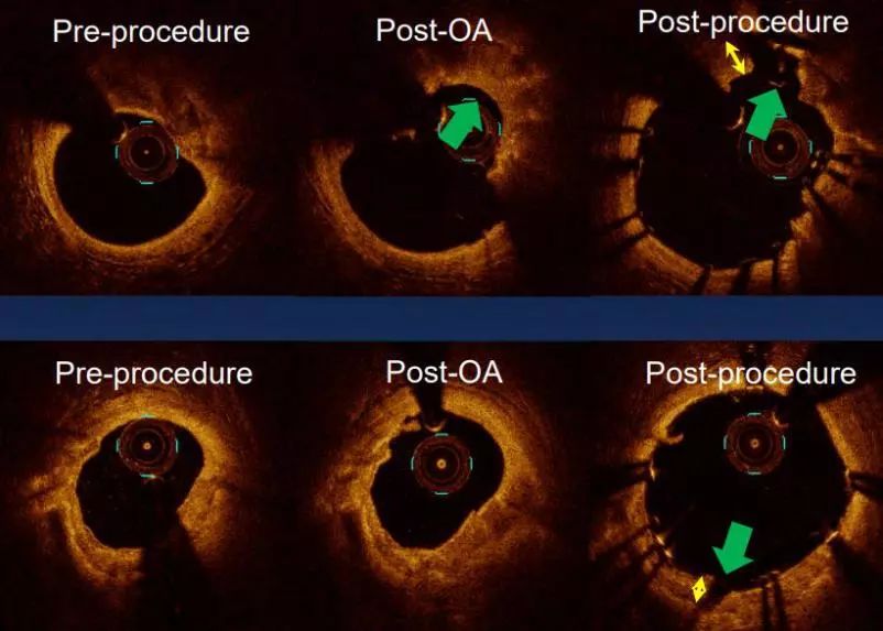 oct閽欏寲鐥呭彉,cit2019灞曚細瑙嗛