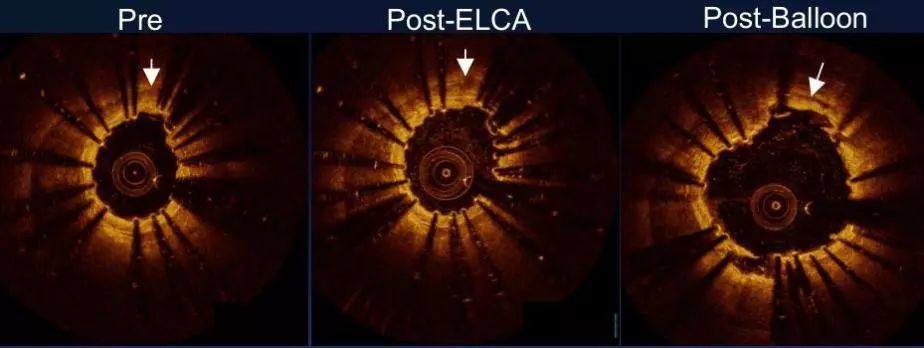 oct閽欏寲鐥呭彉,cit2019灞曚細瑙嗛