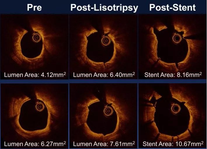 oct閽欏寲鐥呭彉,cit2019灞曚細瑙嗛