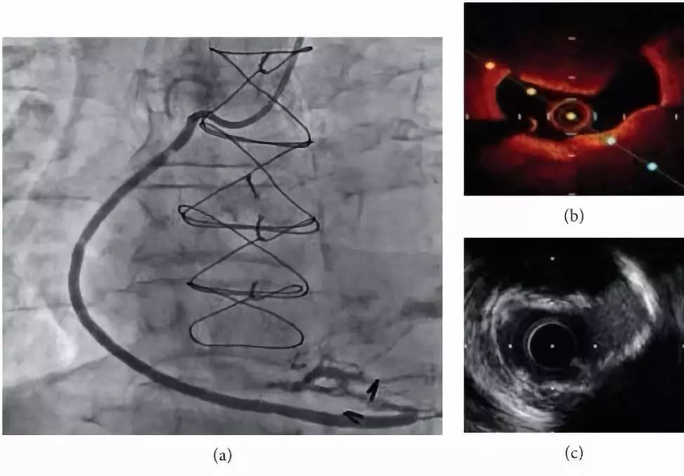 oct閽欏寲鐥呭彉,cit2019灞曚細瑙嗛
