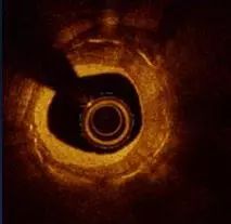 oct閽欏寲鐥呭彉,cit2019灞曚細瑙嗛