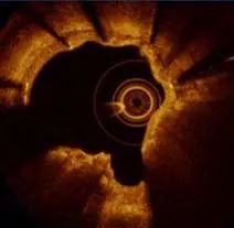 oct閽欏寲鐥呭彉,cit2019灞曚細瑙嗛