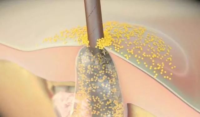 生发长头发神器,脱发生发最新科技