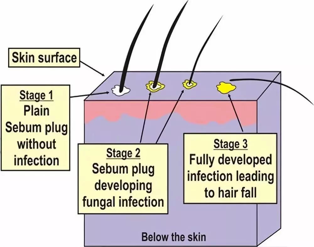 生发长头发神器,脱发生发最新科技