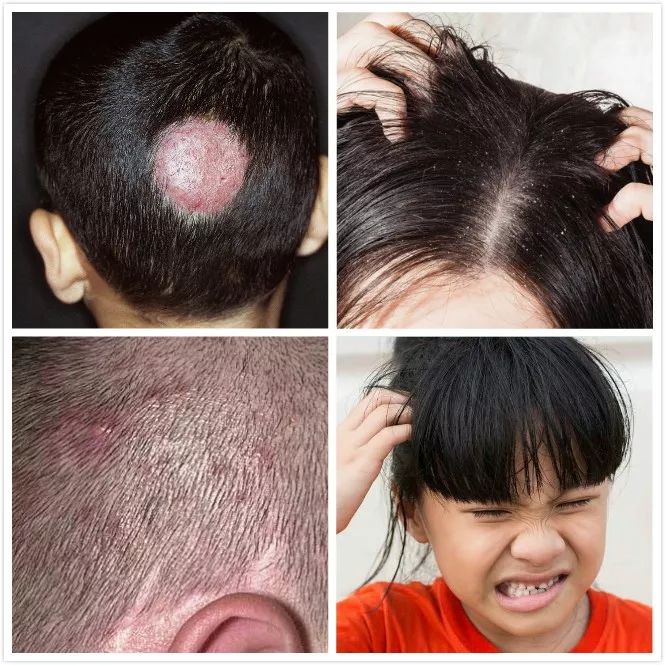 生发长头发神器,脱发生发最新科技