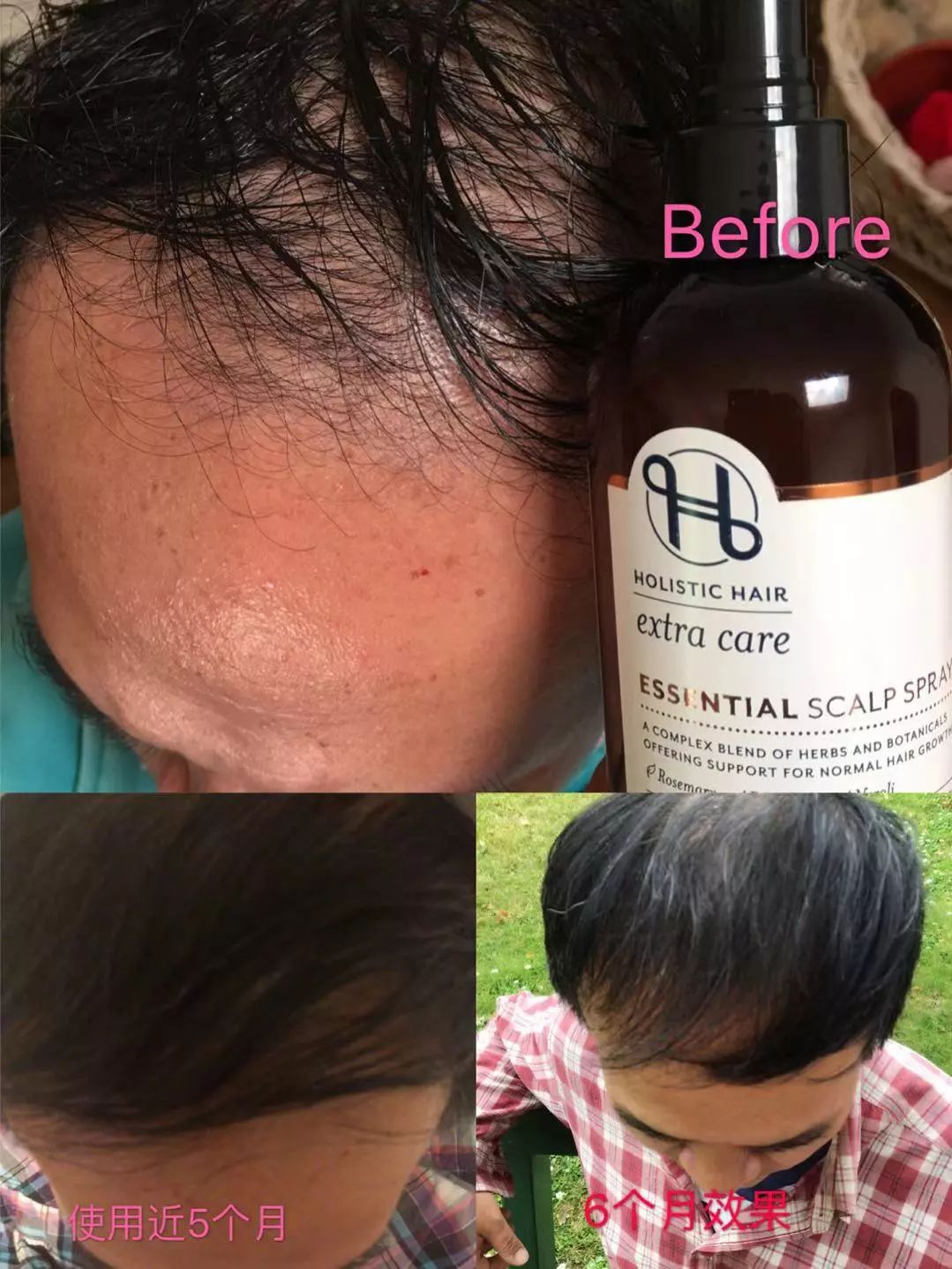 生发长头发神器,脱发生发最新科技