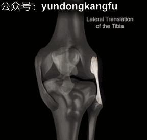 膝内侧副韧带损伤吃什么药,膝韧带损伤预防与康复训练