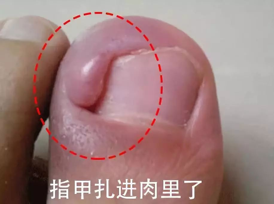 小脚趾甲长在肉里一碰就疼怎么办,指甲扎到肉里怎么处理