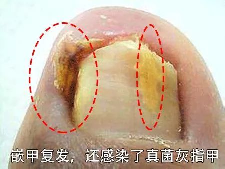 小脚趾甲长在肉里一碰就疼怎么办,指甲扎到肉里怎么处理