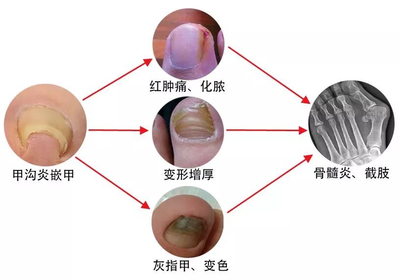 小脚趾甲长在肉里一碰就疼怎么办,指甲扎到肉里怎么处理