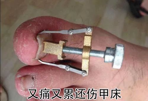 小脚趾甲长在肉里一碰就疼怎么办,指甲扎到肉里怎么处理