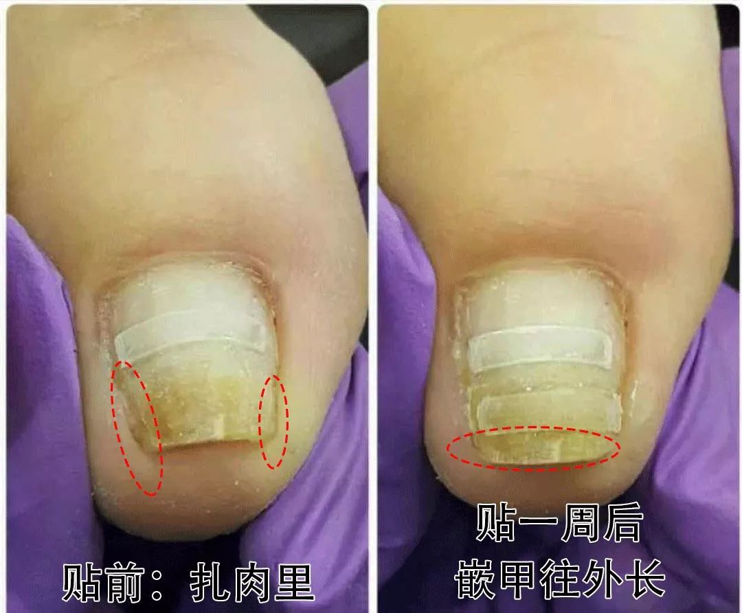 小脚趾甲长在肉里一碰就疼怎么办,指甲扎到肉里怎么处理