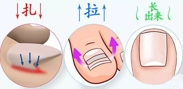 小脚趾甲长在肉里一碰就疼怎么办,指甲扎到肉里怎么处理