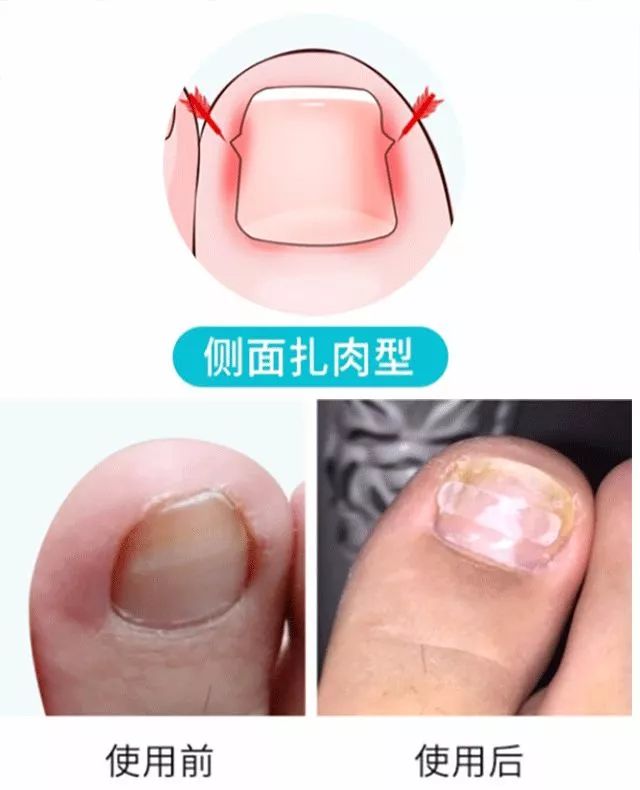 小脚趾甲长在肉里一碰就疼怎么办,指甲扎到肉里怎么处理