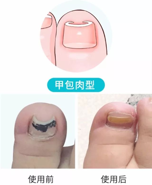 小脚趾甲长在肉里一碰就疼怎么办,指甲扎到肉里怎么处理