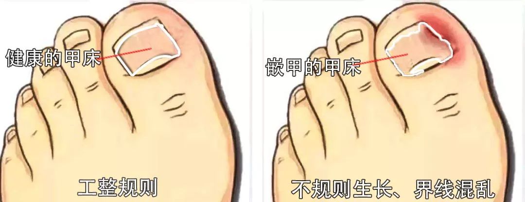 小脚趾甲长在肉里一碰就疼怎么办,指甲扎到肉里怎么处理