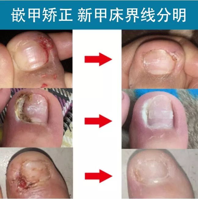 小脚趾甲长在肉里一碰就疼怎么办,指甲扎到肉里怎么处理