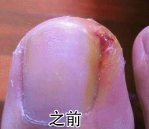 小脚趾甲长在肉里一碰就疼怎么办,指甲扎到肉里怎么处理