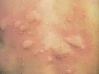 运动后出现荨麻疹是怎么回事,运动后荨麻疹是什么原因