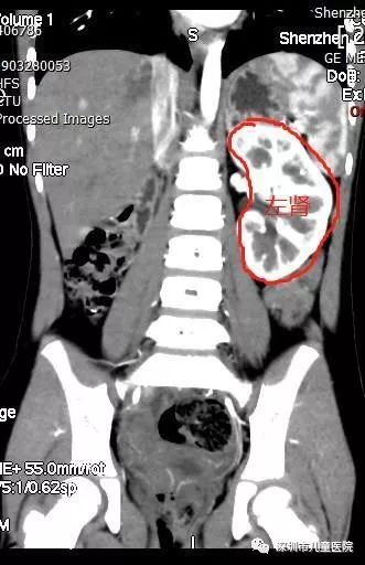 六岁的她每天都用“姨妈巾”，罪魁祸首是……家长注意，这怪病“偏爱”女孩