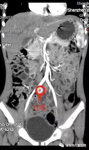 六岁的她每天都用“姨妈巾”，罪魁祸首是……家长注意，这怪病“偏爱”女孩