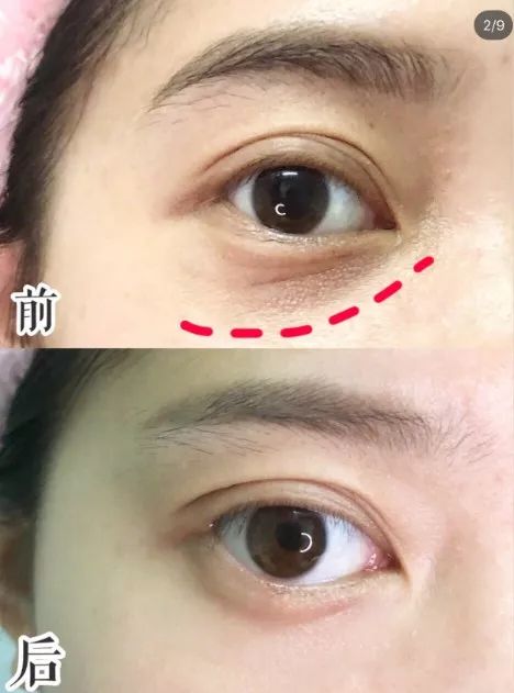 25岁必须用眼霜了吗,25岁之后适合用什么眼霜