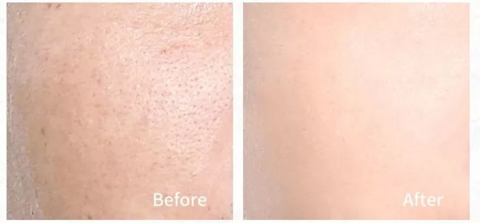 脸部清洁不彻底长痘,如何清理脸上的黑头和痘痘