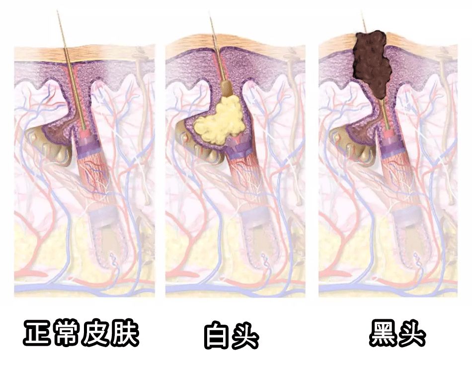 脸部清洁不彻底长痘,如何清理脸上的黑头和痘痘