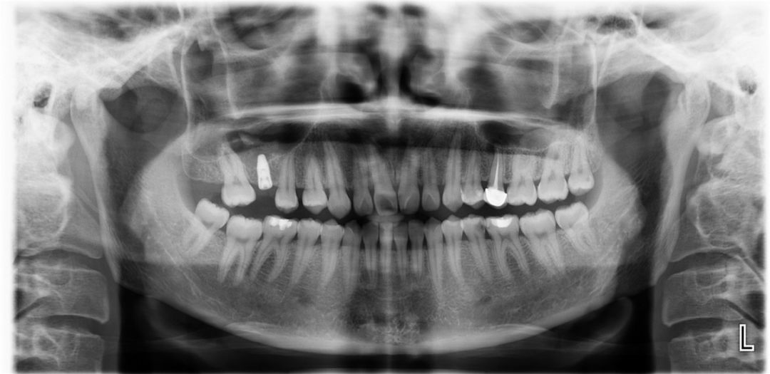 口腔种植零基础培训实操,口腔种植手术课程