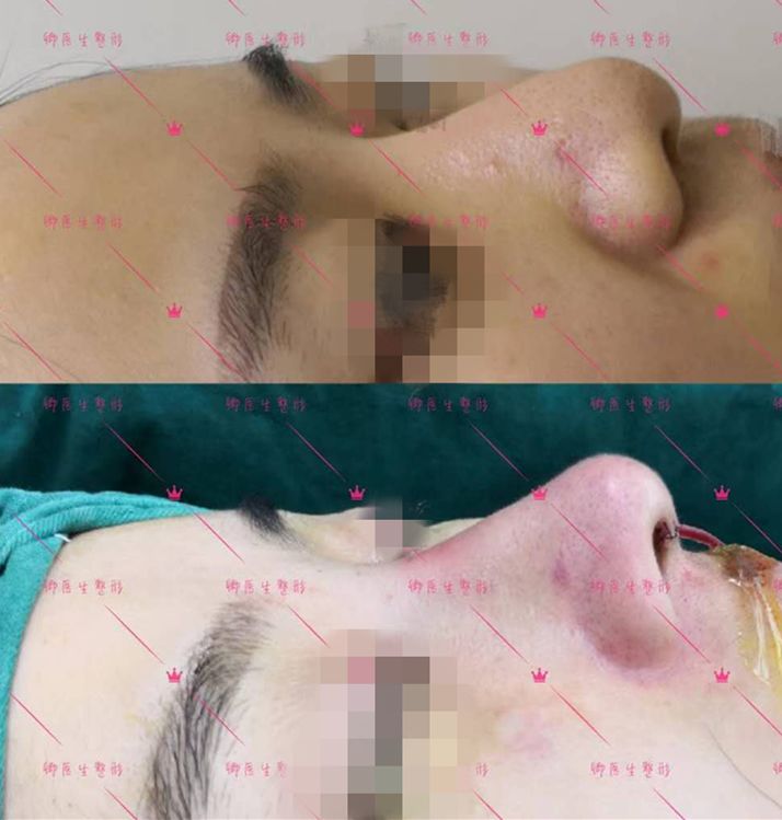 长鼻子如何通过整容改善,鼻子到底应该怎么修