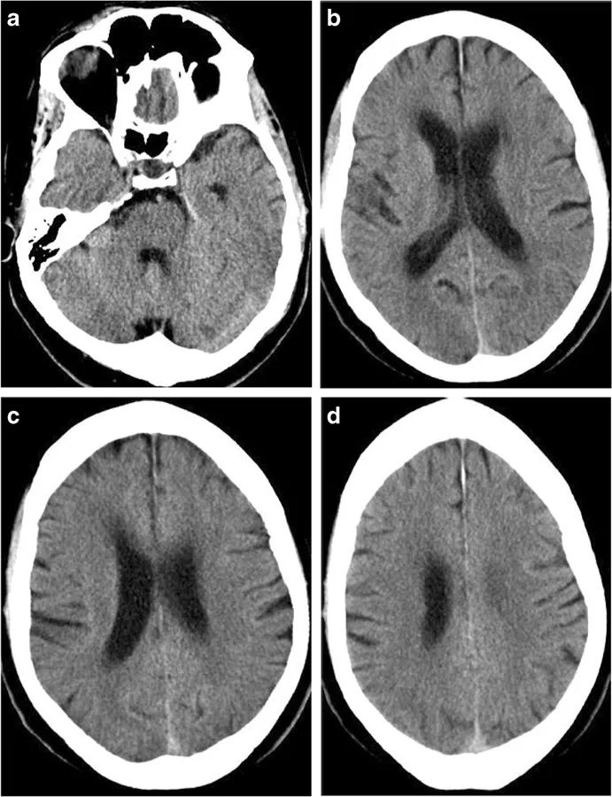 如何平稳度过脑水肿,多种原因导致的脑水肿首选是什么