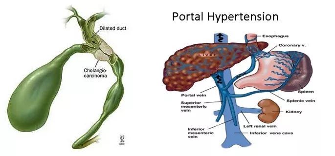 胆囊切除术后腹泻腹痛吃什么药,胆囊切除吃胆宁片腹泻是怎么回事