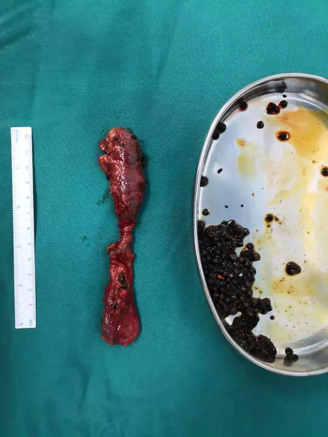 胆囊切除术后腹泻腹痛吃什么药,胆囊切除吃胆宁片腹泻是怎么回事