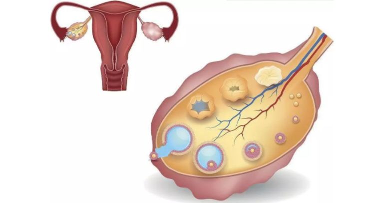 卵巢早衰干细胞招募,湘雅有干细胞治疗卵巢早衰的吗