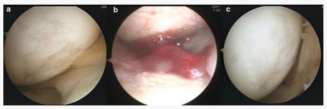 膝关节软骨退化干细胞治疗,间充质干细胞治疗膝关节
