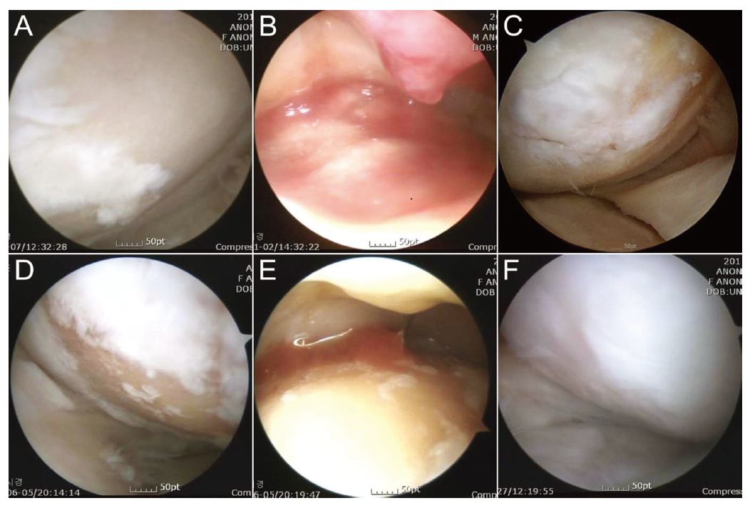 膝关节软骨退化干细胞治疗,间充质干细胞治疗膝关节
