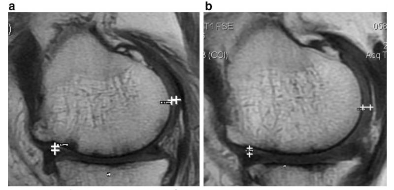 膝关节软骨退化干细胞治疗,间充质干细胞治疗膝关节