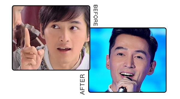 戴牙套换粗钢丝,拔四颗牙戴牙套的脸型变化图