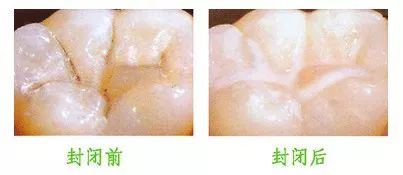 窝沟封闭脱落会更容易蛀牙吗,窝沟封闭防龋齿是怎么回事