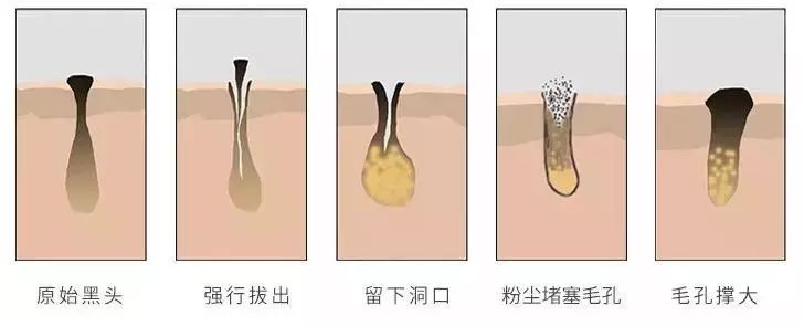 白头黑头到底拔不拔,黑头反反复复如何根治