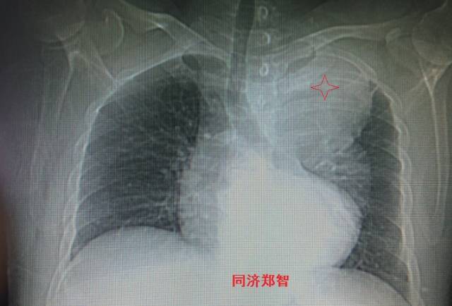 没有cta这三招也能识别主动脉夹层,磁共振可以替代cta检查主动脉夹层