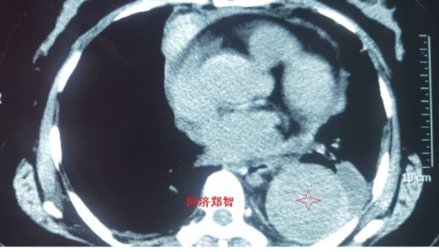 没有cta这三招也能识别主动脉夹层,磁共振可以替代cta检查主动脉夹层