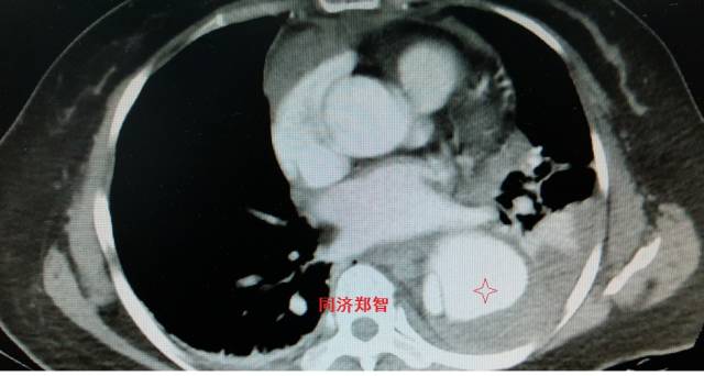 没有cta这三招也能识别主动脉夹层,磁共振可以替代cta检查主动脉夹层