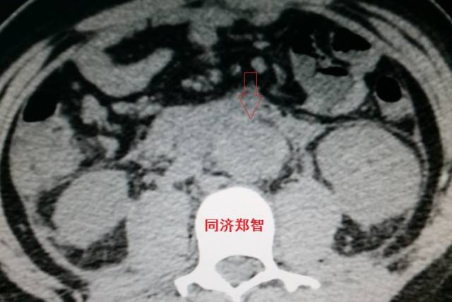 没有cta这三招也能识别主动脉夹层,磁共振可以替代cta检查主动脉夹层