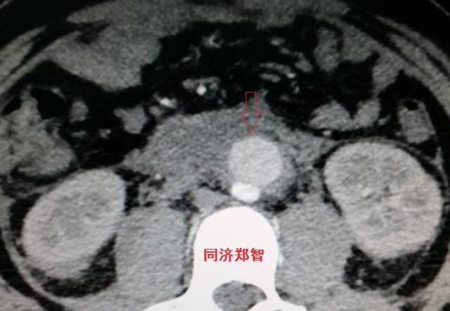没有cta这三招也能识别主动脉夹层,磁共振可以替代cta检查主动脉夹层