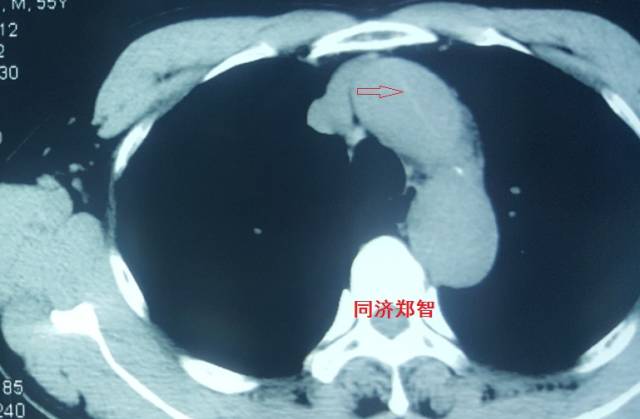 没有cta这三招也能识别主动脉夹层,磁共振可以替代cta检查主动脉夹层