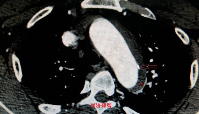 没有cta这三招也能识别主动脉夹层,磁共振可以替代cta检查主动脉夹层